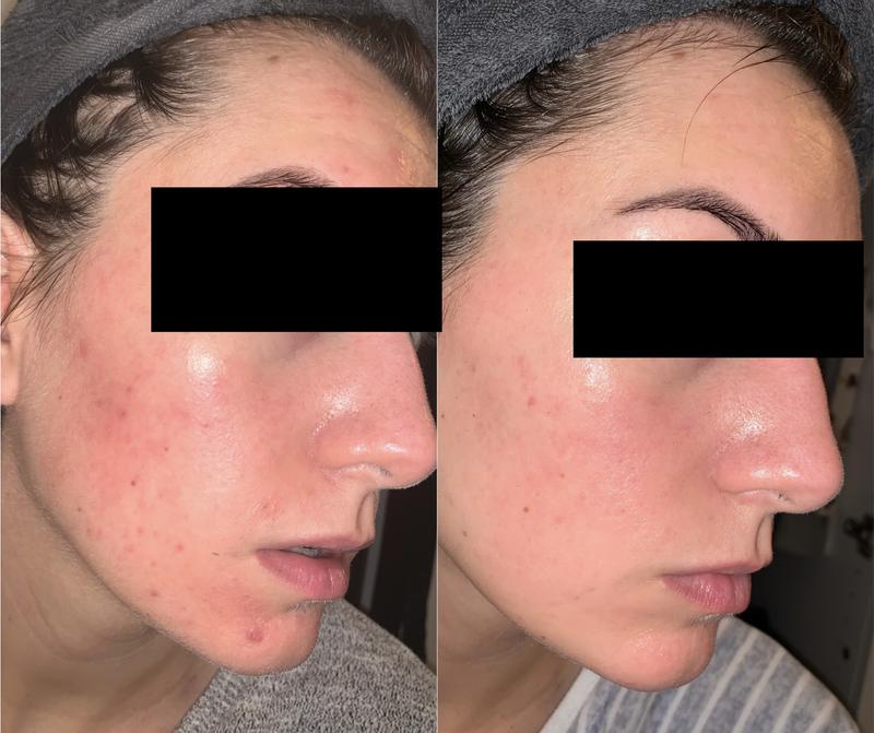 نتایج استفاده از سرم رتینول اوردینری