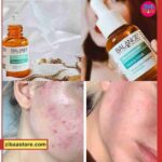 سرم ضدجوش و ضدلک نیاسینامید بالانس حجم 30 میلی لیتر