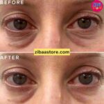 قبل و بعد استفاده از کرم دور چشم طلا و کلاژن بالانس