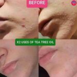 قبل و بعد استفاده از روغن تی تری اویل بادی شاپ