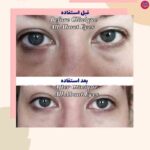 قبل و بعد استفاده از دور چشم ریچ کلینیک