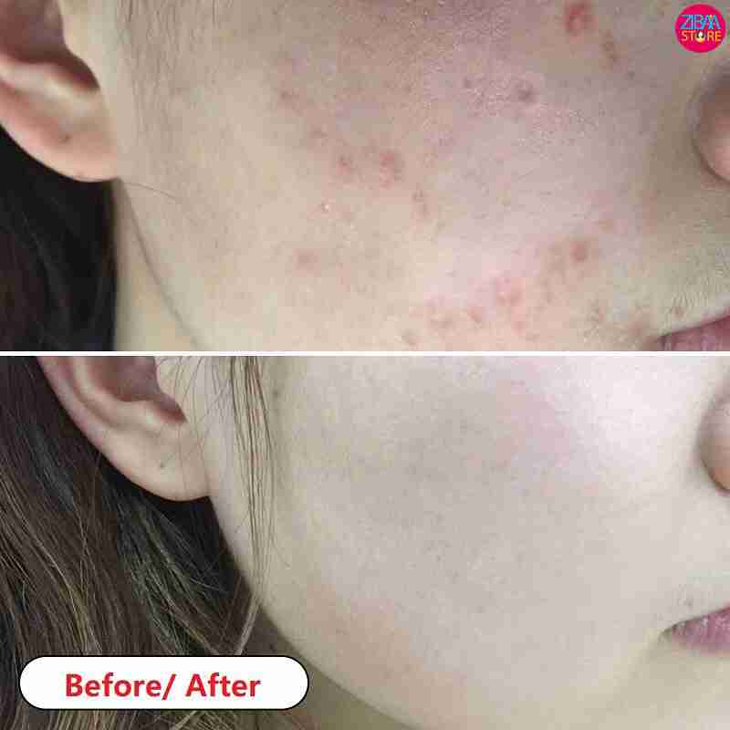 قبل و بعد استفاده از روغن درخت چای بادی شاپ