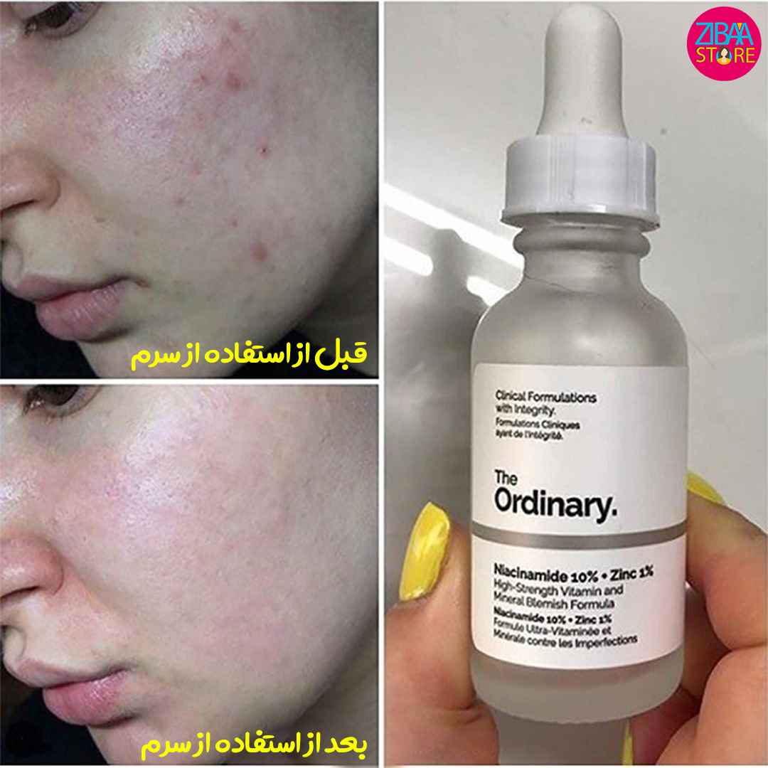سرم نیاسینامید اوردینری برای جای جوش