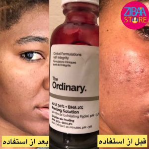 سرم پیلینگ اوردینری لایه بردار قوی (30ml)
