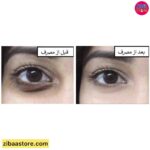کرم دور چشم اسنک ونوم بالانس