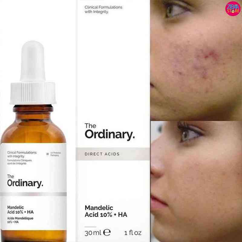 قبل و بعد استفاده از سرم ماندلیک اسید اوردینری