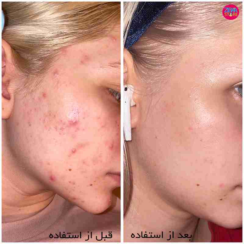 قبل و بعد استفاده از سرم لایه بردار لاکتیک اسید 5% اوردینری