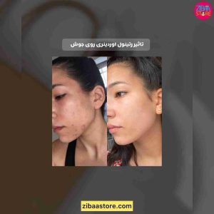 سرم رتینول یک درصد اوردینری
