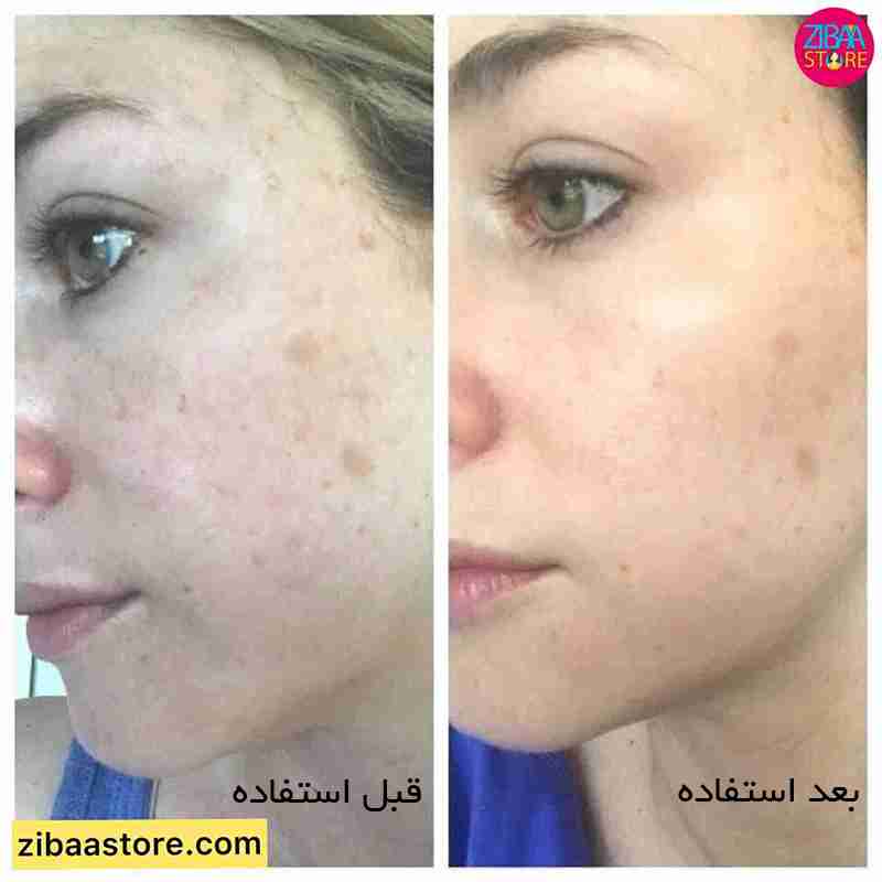 قبل و بعد استفاده از سرم لاکتیک اسید اوردینری ۱۰ درصد