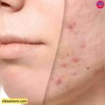 قبل و بعد استفاده از لاکتیک اسید ده درصد اوردینری