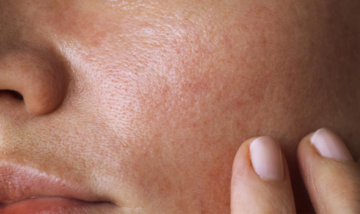 چه چیزی باعث پوست چرب می‌شود و چگونه آن را مدیریت کنیم؟